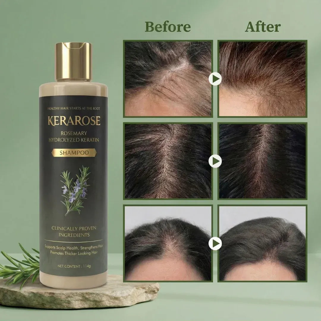 (BUY 1 GET 1 FREE) Kerarose - Magic Rosemary Hair Growth Shampoo